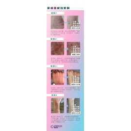 犀補靈濕疹抑制膏